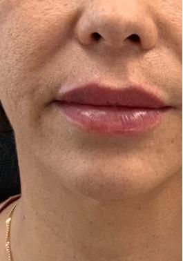 Lip Filler after at Skin Perfect Medical Aesthetics in Costa Mesa, CA