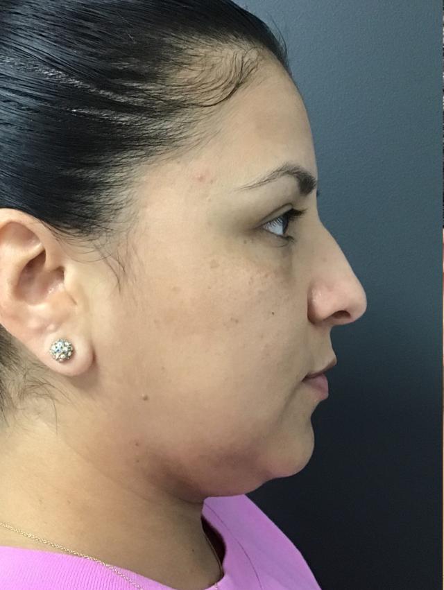 CoolSculpting before at Skin Perfect Medical Aesthetics in Costa Mesa, CA