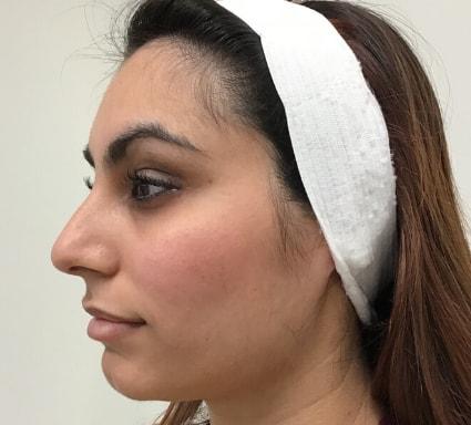 Laser Skin Resurfacing before at Skin Perfect Medical Aesthetics in Costa Mesa, CA