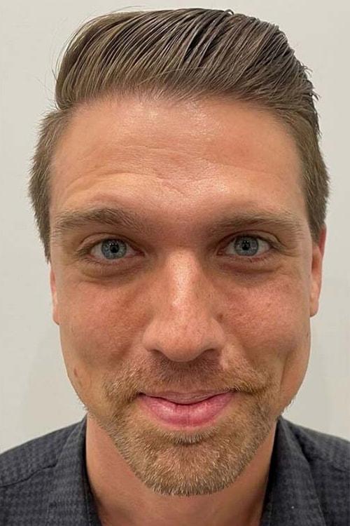 Skin Perfect Medical Aesthetics botox after — Costa Mesa, CA
