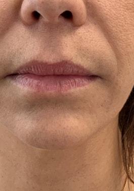 Lip Filler before at Skin Perfect Medical Aesthetics in Costa Mesa, CA