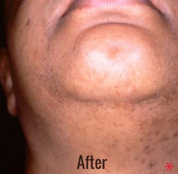 Skin Perfect Medical Aesthetics after — Costa Mesa, CA
