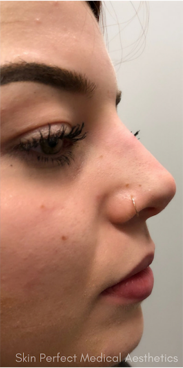 Rhinoplasty after at Skin Perfect Medical Aesthetics in Costa Mesa, CA