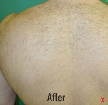Skin Perfect Medical Aesthetics after — Costa Mesa, CA