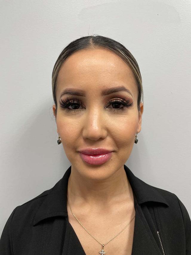 Lip Filler after at Skin Perfect Medical Aesthetics in Costa Mesa, CA