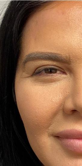 Skin Perfect Medical Aesthetics botox after — Costa Mesa, CA