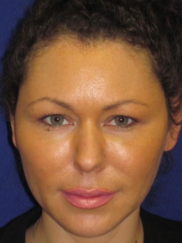 Anthony Corrado, MD fat transfer after — Cherry Hill Township, NJ