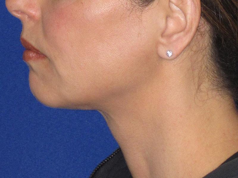 Anthony Corrado, MD neck liposuction after — Cherry Hill Township, NJ