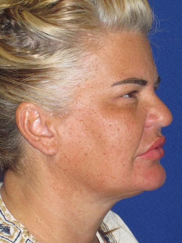 Anthony Corrado, MD neck liposuction after — Cherry Hill Township, NJ
