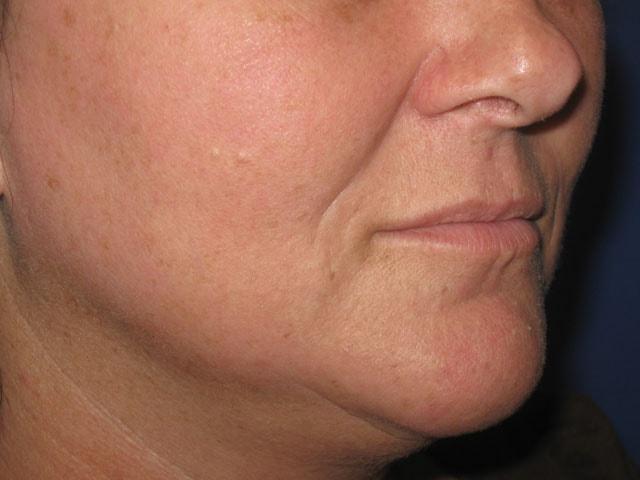 Anthony Corrado, MD laser treatment after — Cherry Hill Township, NJ
