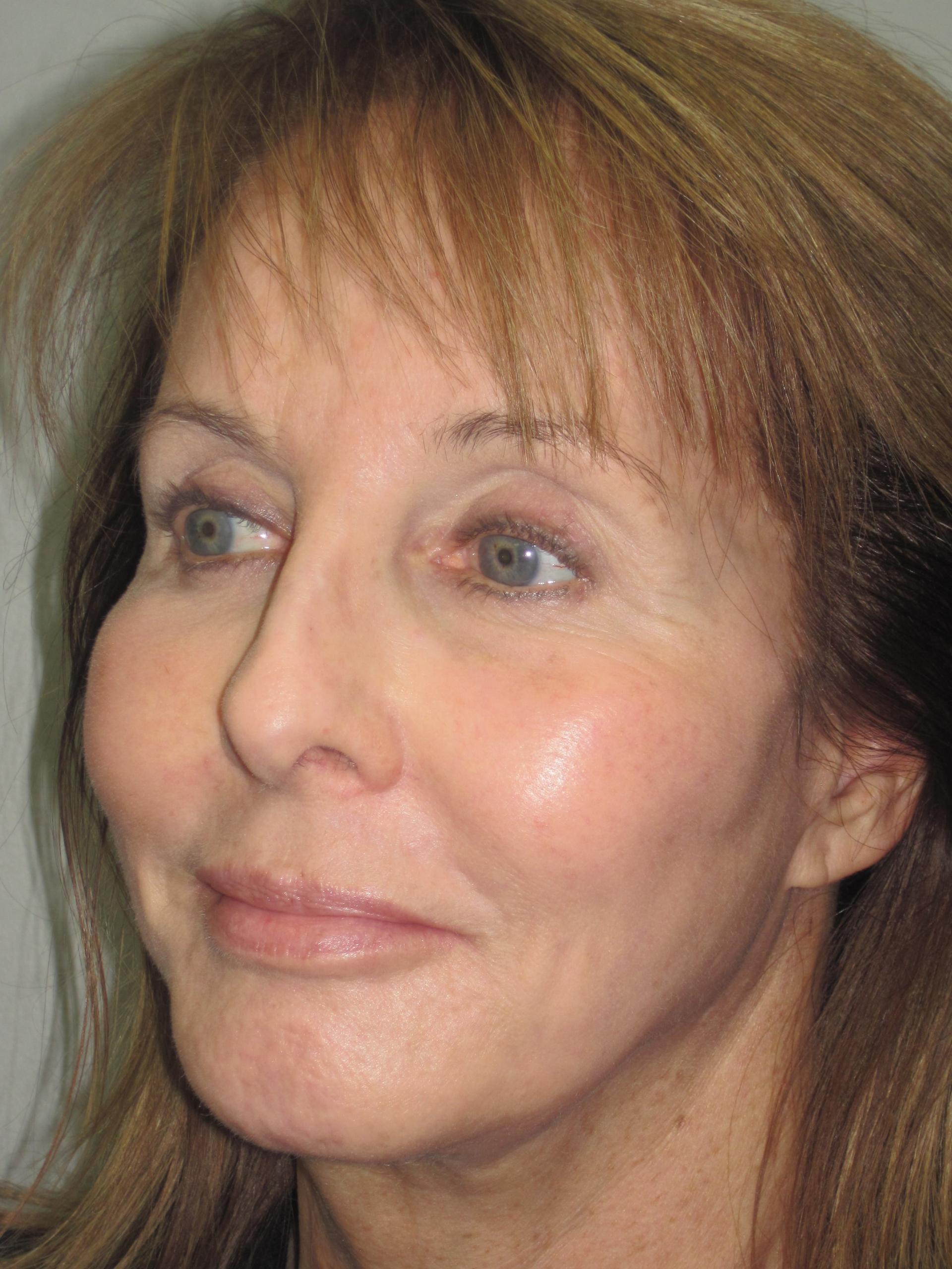 Anthony Corrado, MD fat transfer after — Cherry Hill Township, NJ