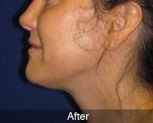 Anthony Corrado, MD neck liposuction after — Cherry Hill Township, NJ