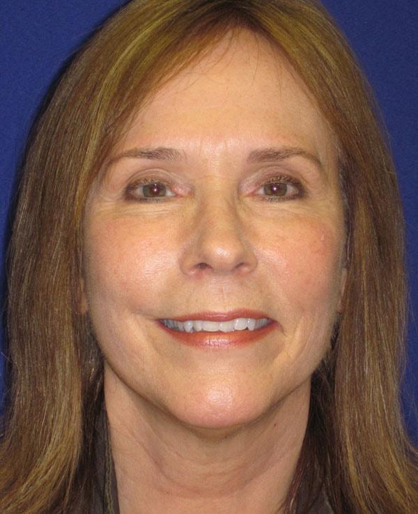 Anthony Corrado, MD fat transfer after — Cherry Hill Township, NJ
