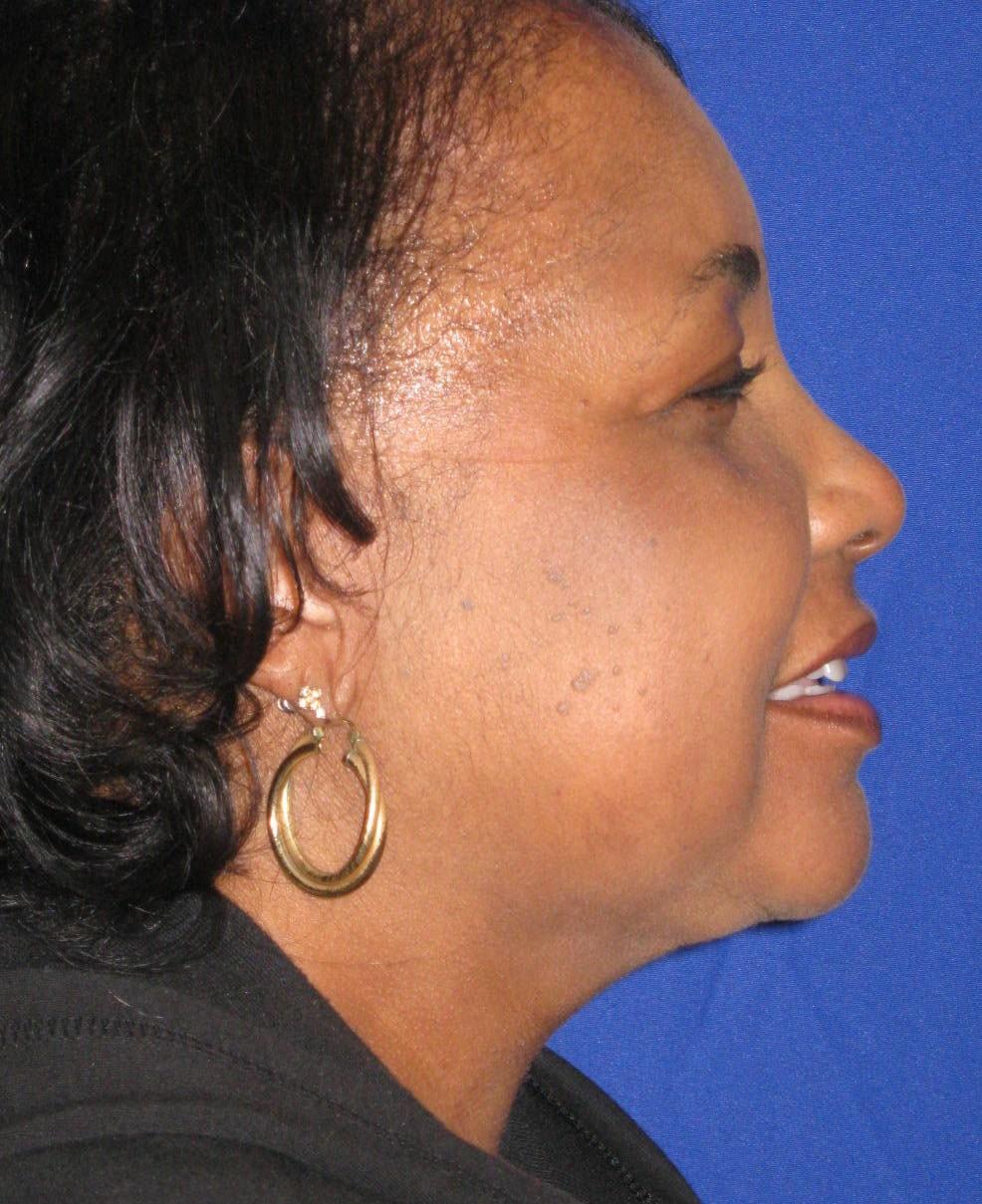 Anthony Corrado, MD neck liposuction after — Cherry Hill Township, NJ
