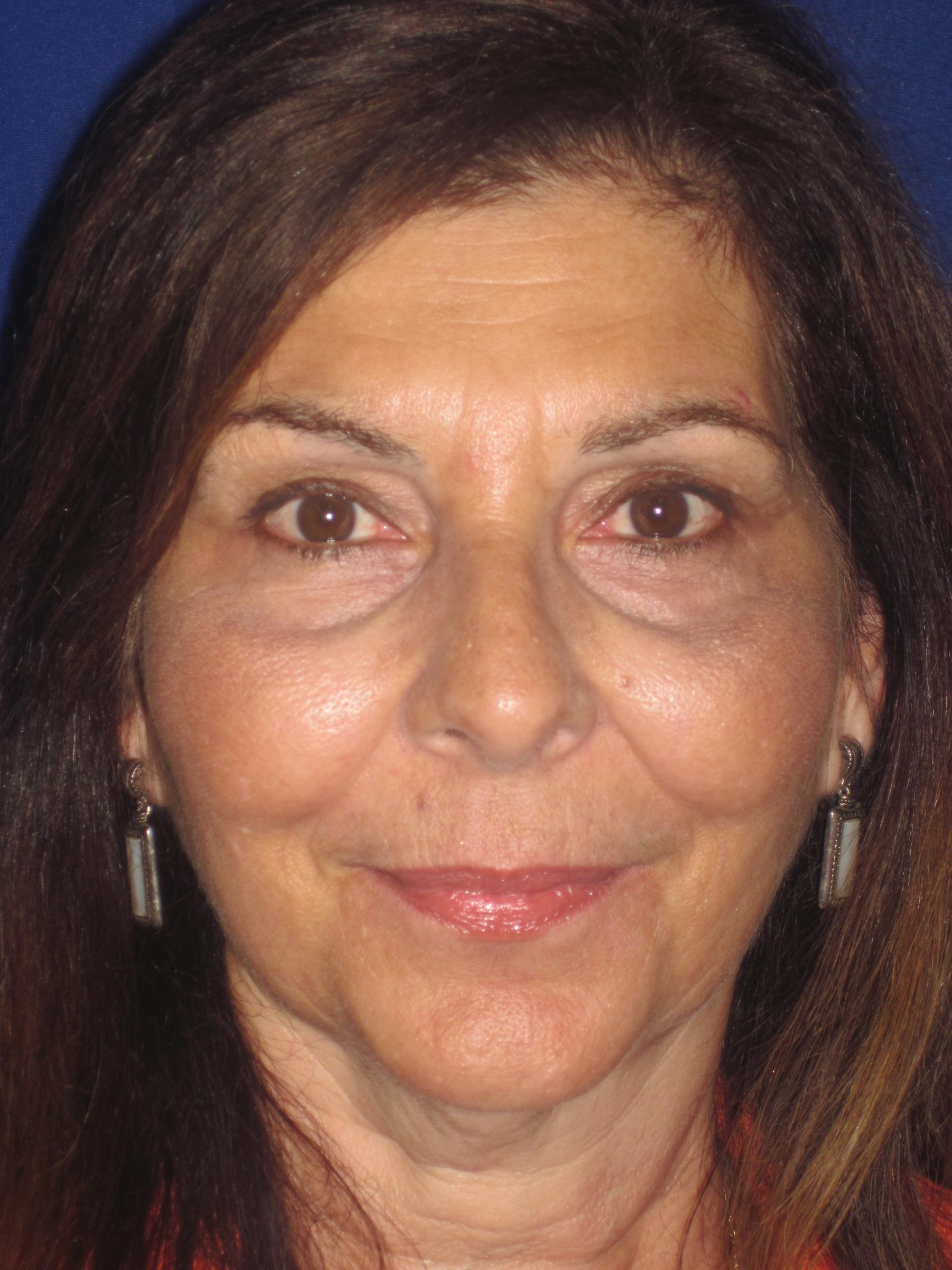 Anthony Corrado, MD laser treatment after — Cherry Hill Township, NJ