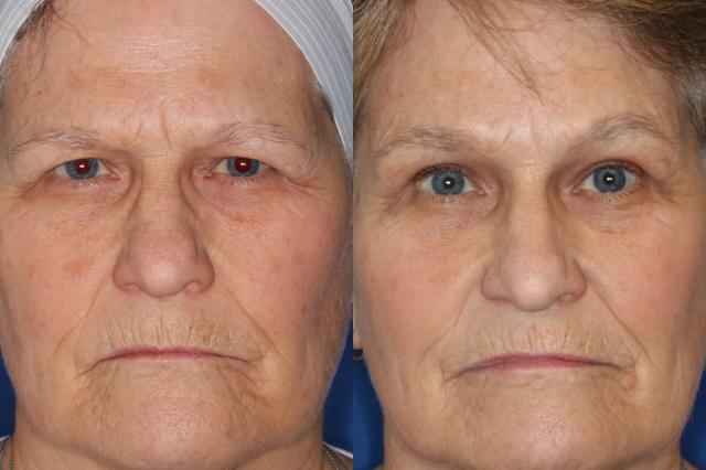 Brow Lift result at Francisco Castillo, MD in Portland, OR