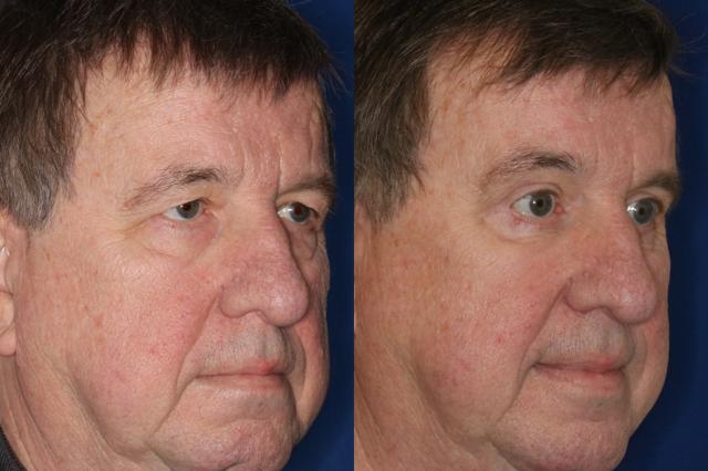 Brow Lift result at Francisco Castillo, MD in Portland, OR