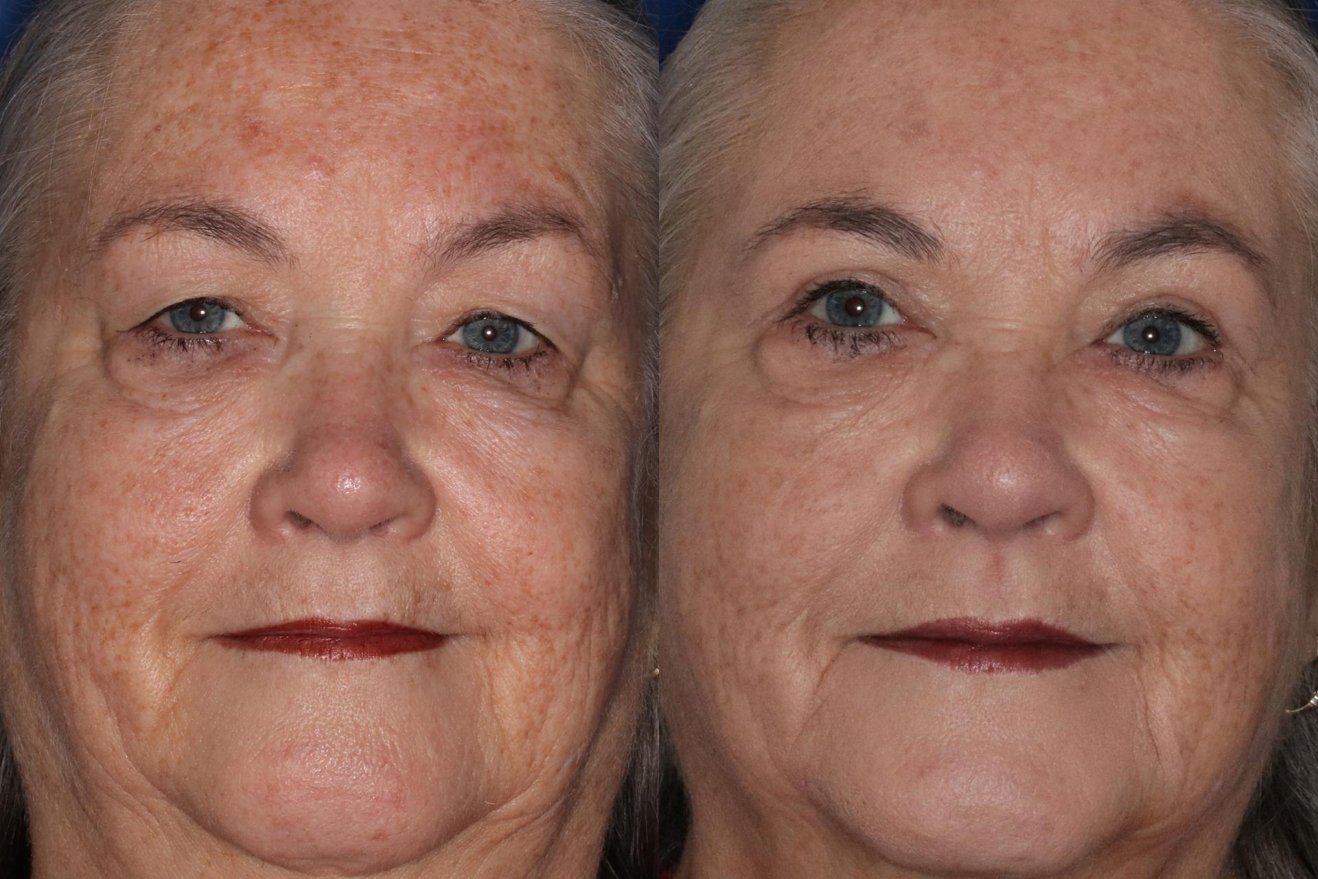 Francisco Castillo, MD eyelid lift result — Portland, OR