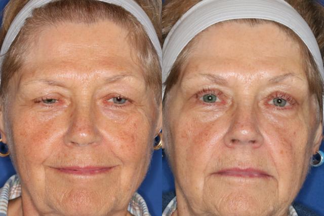 Brow Lift result at Francisco Castillo, MD in Portland, OR