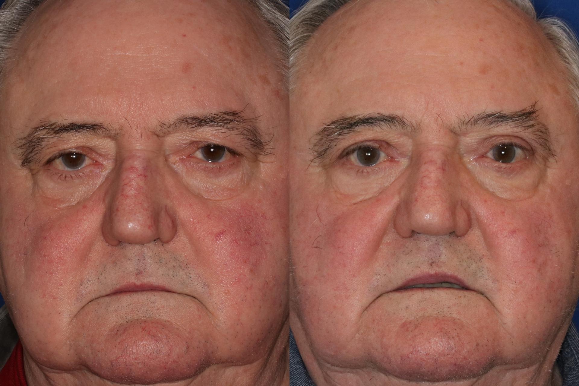 Francisco Castillo, MD eyelid lift result — Portland, OR