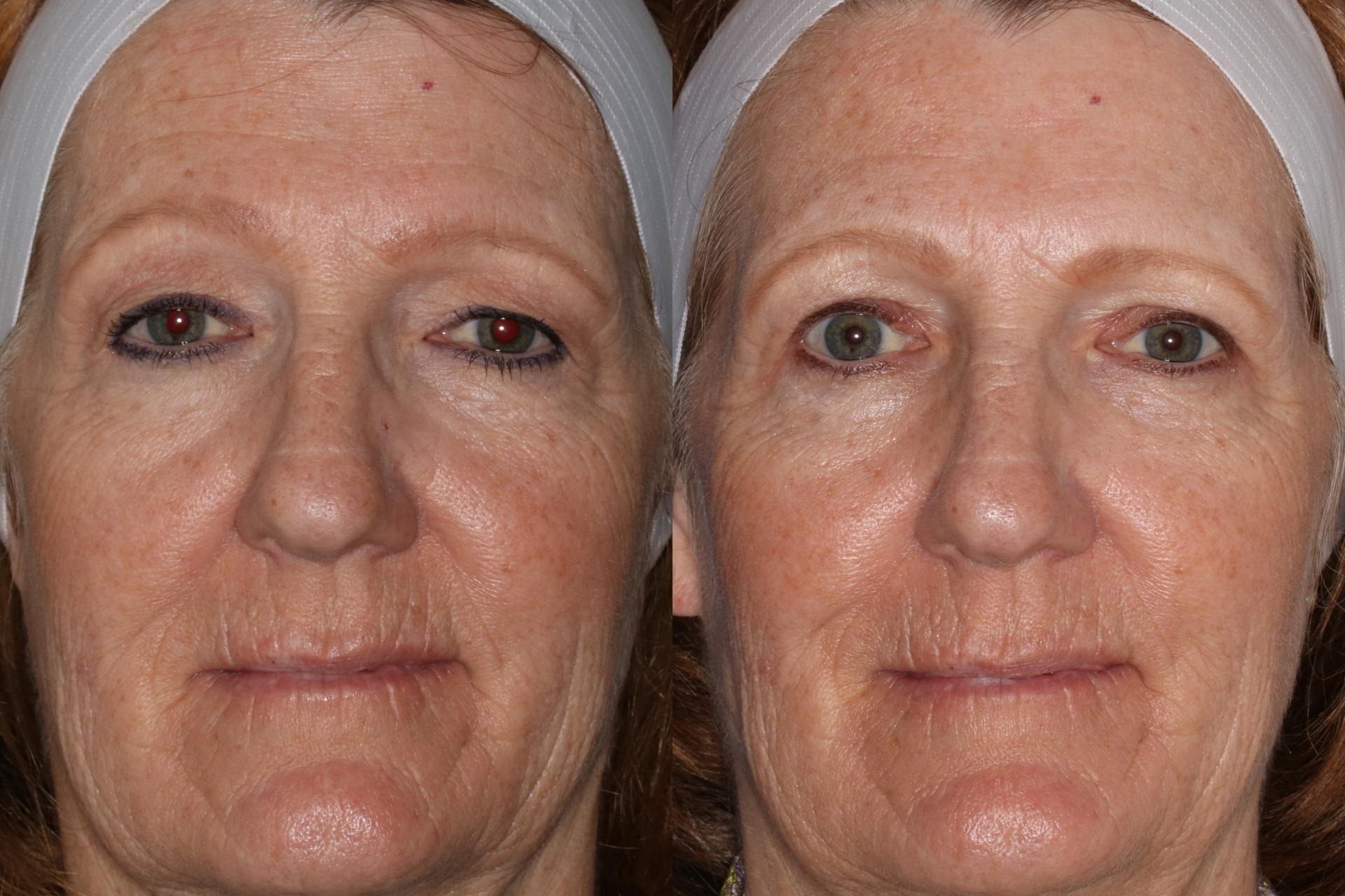 Francisco Castillo, MD eyelid lift result — Portland, OR