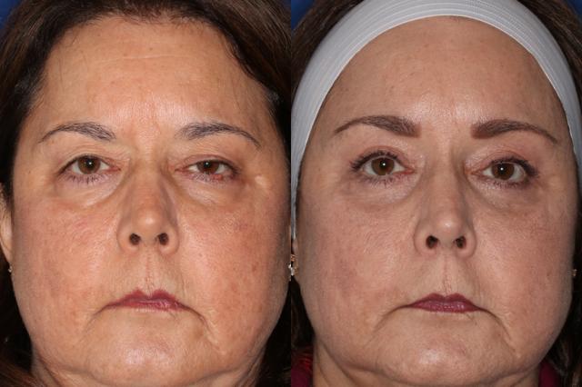 Brow Lift result at Francisco Castillo, MD in Portland, OR