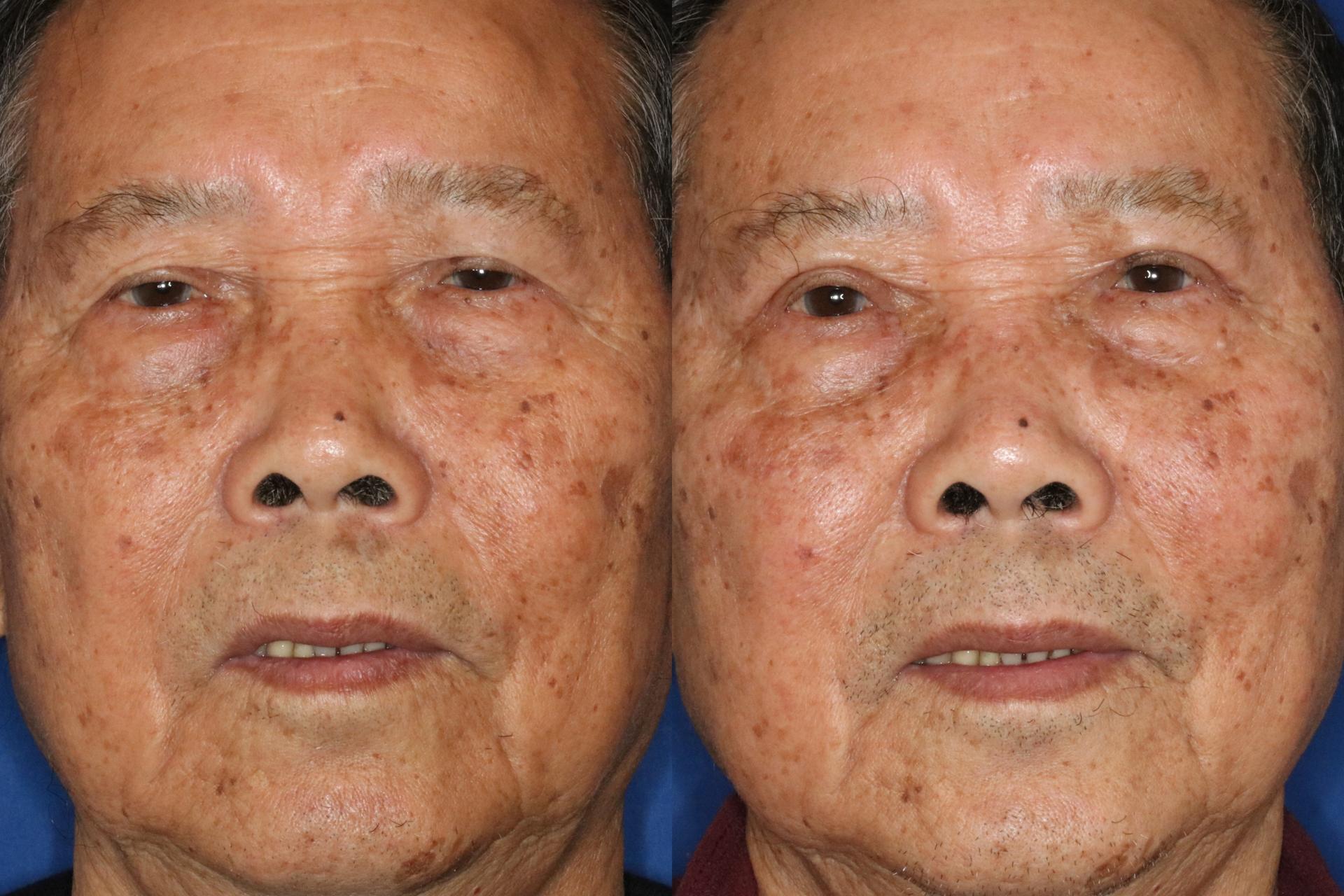 Francisco Castillo, MD eyelid lift result — Portland, OR