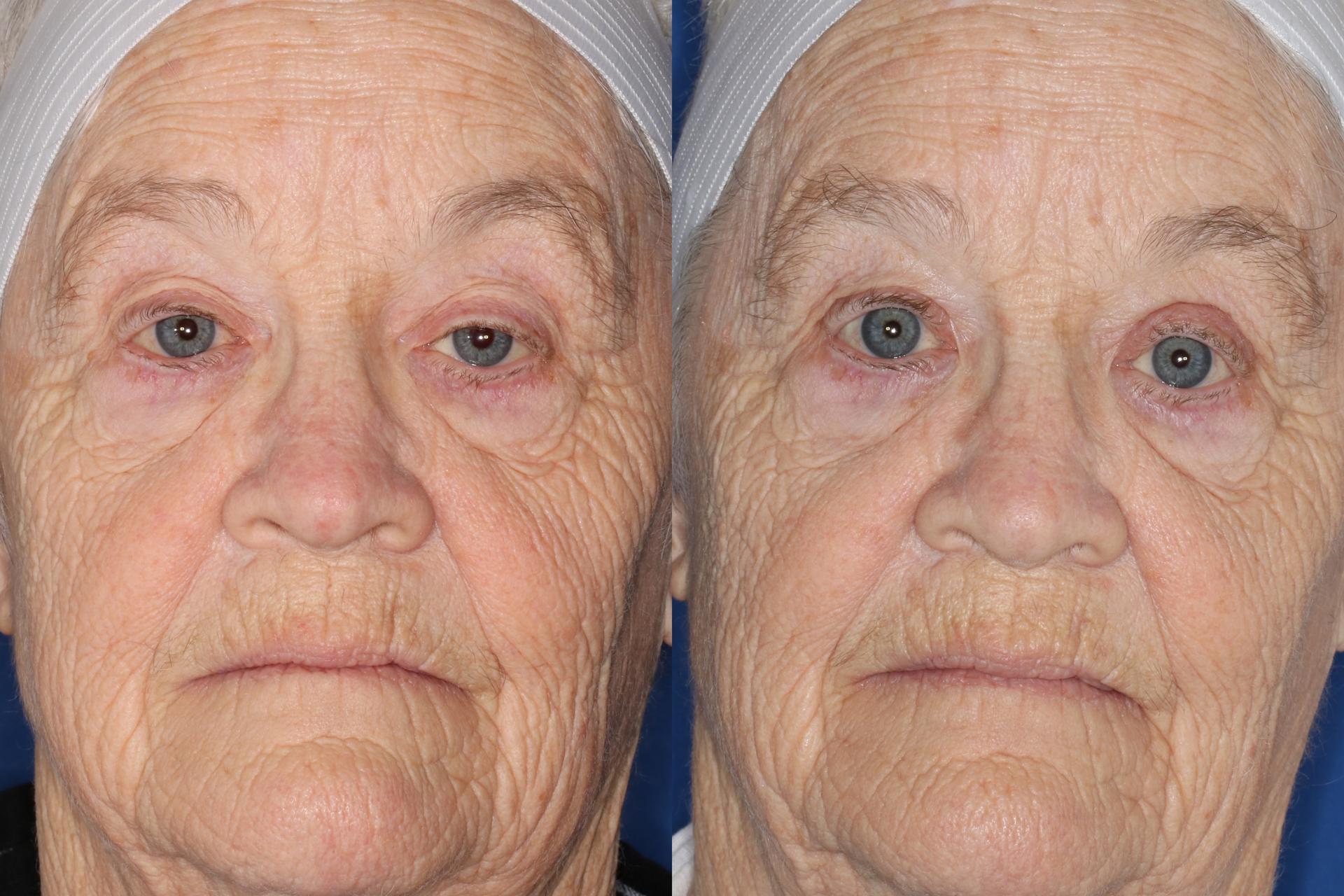 Francisco Castillo, MD eyelid lift result — Portland, OR