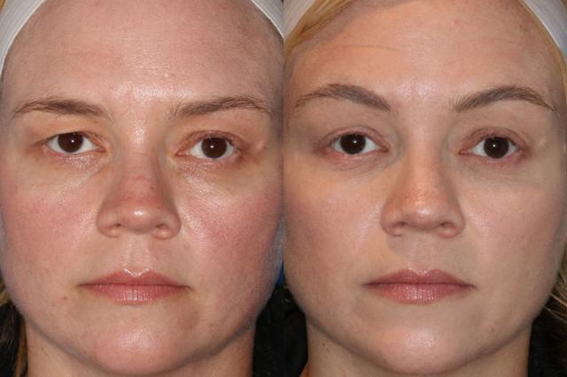 Brow Lift result at Francisco Castillo, MD in Portland, OR