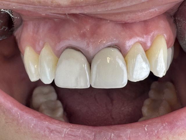 Smile Makeover before at Dentistry For Life in Fort Worth, TX