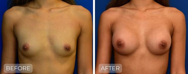 Breast Augmentation result at John Park MD Plastic Surgery in Newport Beach, CA