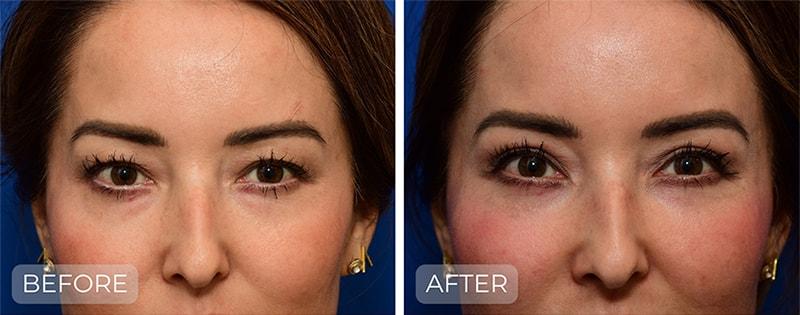 John Park MD Plastic Surgery blepharoplasty result — Newport Beach, CA