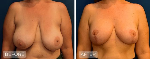 Breast Reduction result at John Park MD Plastic Surgery in Newport Beach, CA