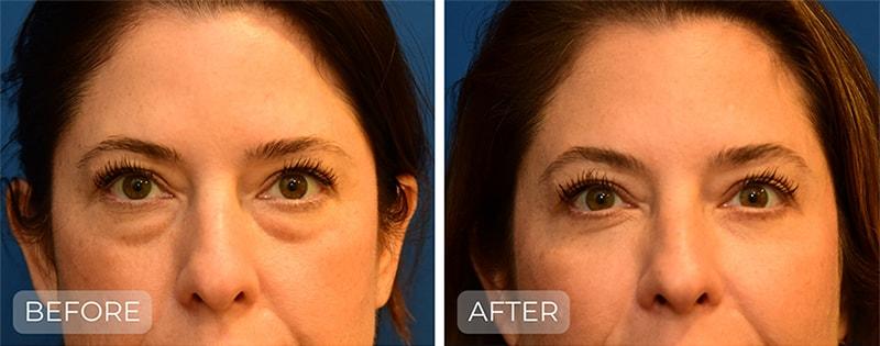 John Park MD Plastic Surgery blepharoplasty result — Newport Beach, CA