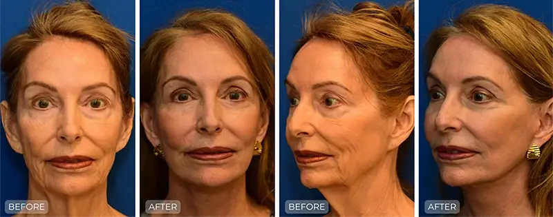 John Park MD Plastic Surgery facelift result — Newport Beach, CA