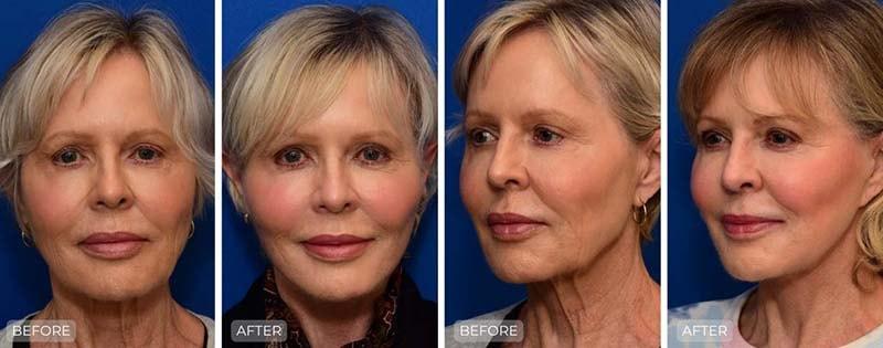 John Park MD Plastic Surgery facelift result — Newport Beach, CA