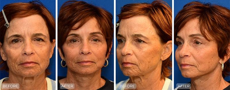 John Park MD Plastic Surgery facelift result — Newport Beach, CA
