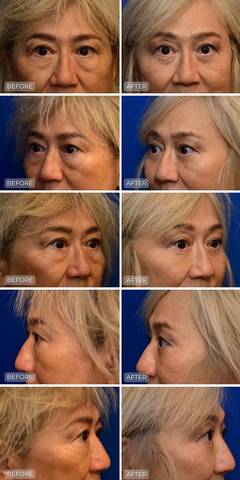 John Park MD Plastic Surgery blepharoplasty result — Newport Beach, CA