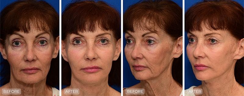 John Park MD Plastic Surgery facelift result — Newport Beach, CA