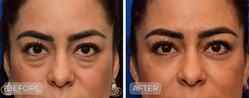 John Park MD Plastic Surgery blepharoplasty result — Newport Beach, CA