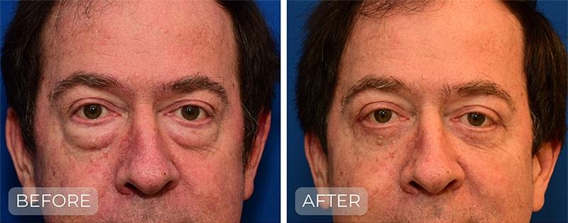 John Park MD Plastic Surgery blepharoplasty result — Newport Beach, CA