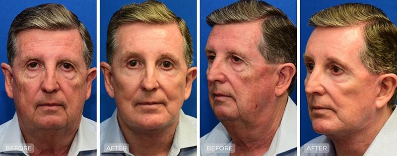 John Park MD Plastic Surgery facelift result — Newport Beach, CA