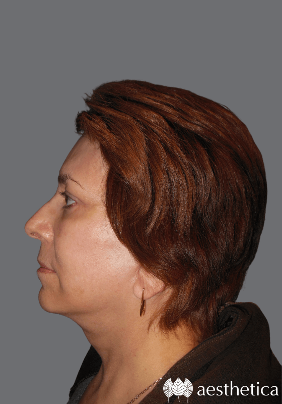 Aesthetica Plastic Surgery facelift after — Lindon, UT