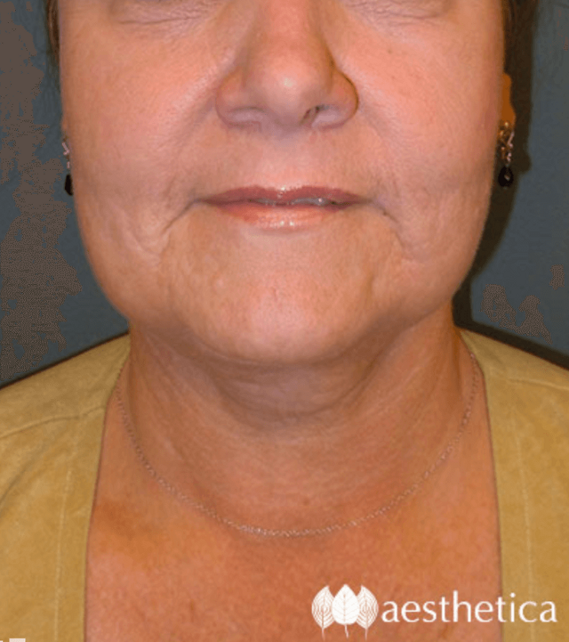 Neck Lift after at Aesthetica Plastic Surgery in Lindon, UT