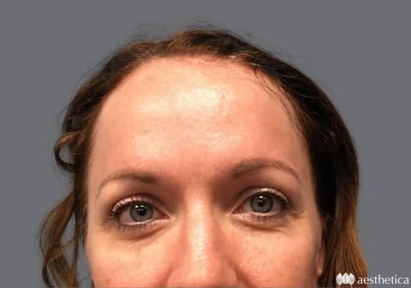 Aesthetica Plastic Surgery eyelid lift after — Lindon, UT