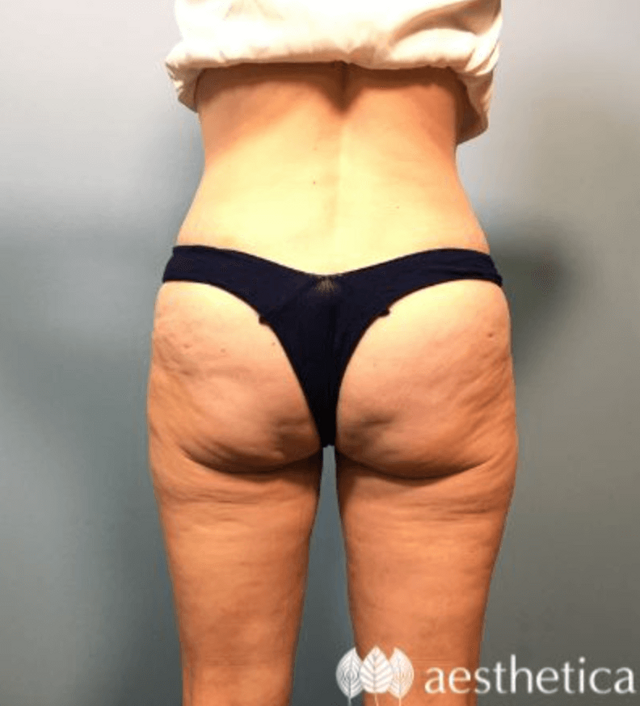 Brazilian Butt Lift after at Aesthetica Plastic Surgery in Lindon, UT
