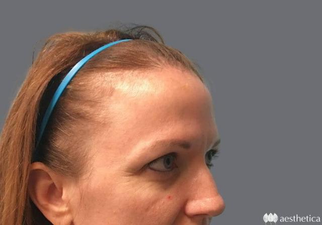 Blepharoplasty before at Aesthetica Plastic Surgery in Lindon, UT