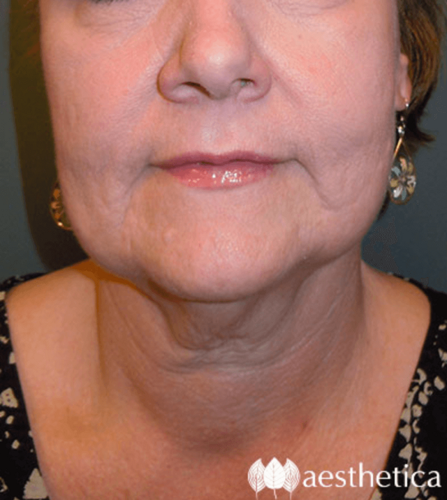 Neck Lift before at Aesthetica Plastic Surgery in Lindon, UT