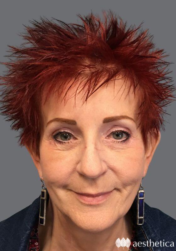 Brow Lift after at Aesthetica Plastic Surgery in Lindon, UT