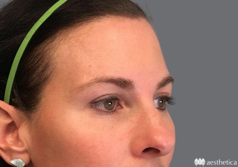Aesthetica Plastic Surgery eyelid lift after — Lindon, UT